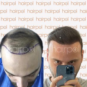 hairpol_before-and-after-hair-transplant-1